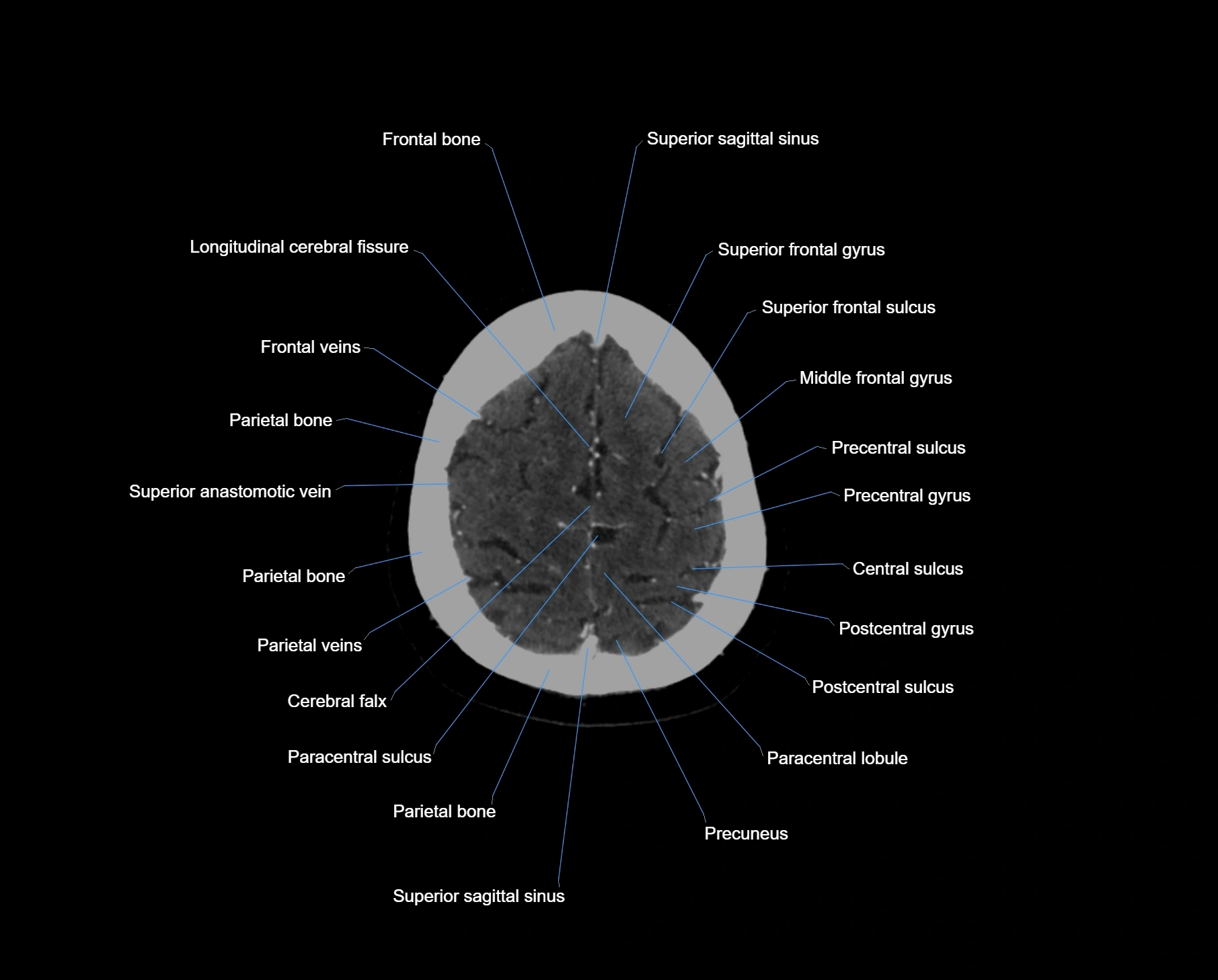 CT scan brain axial labelled cross sectional anatomy image-img-000062.webp